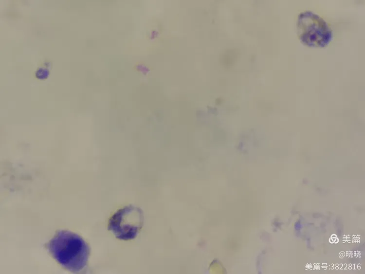 三种疟原虫厚膜染色法对比